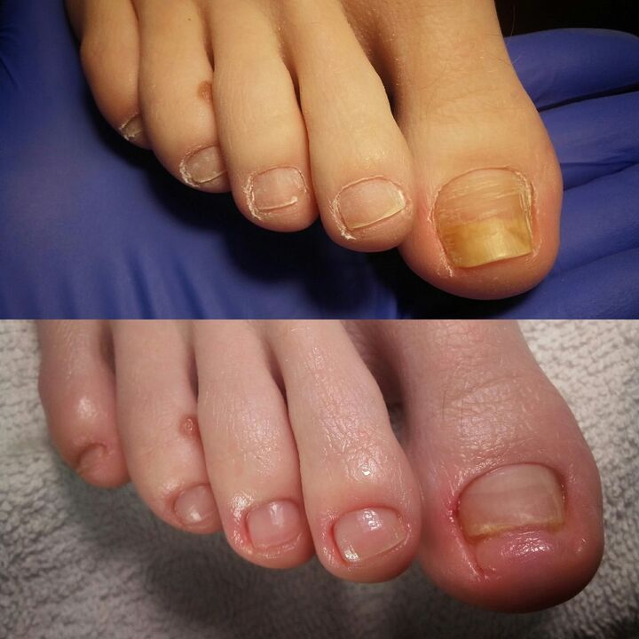 Before and after applying the Exodermin cream from Yesenia