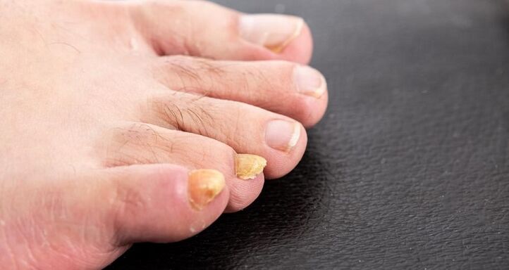 Yellowing of the nails with Nribka on the feet