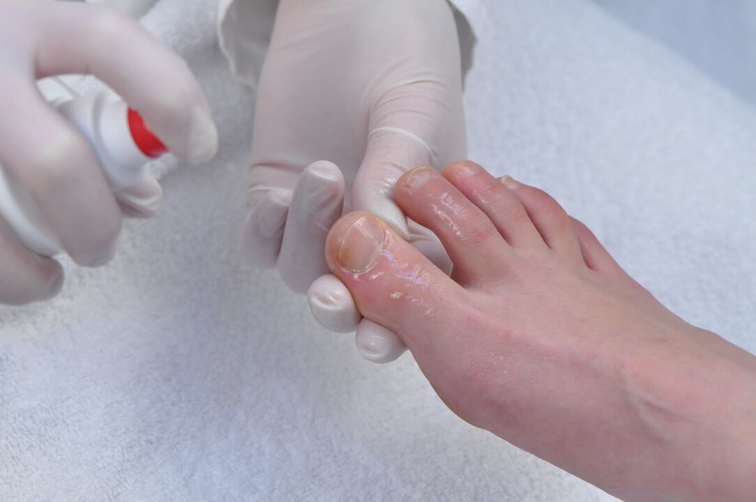 Treatment of toenails with fungus