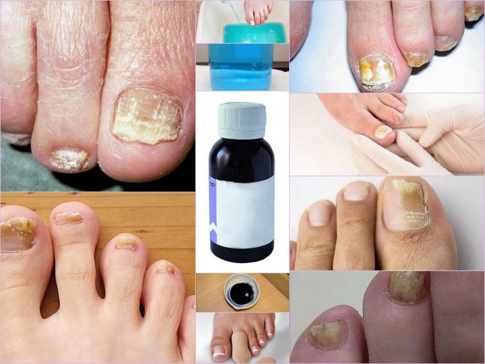 Toenail fungus medication