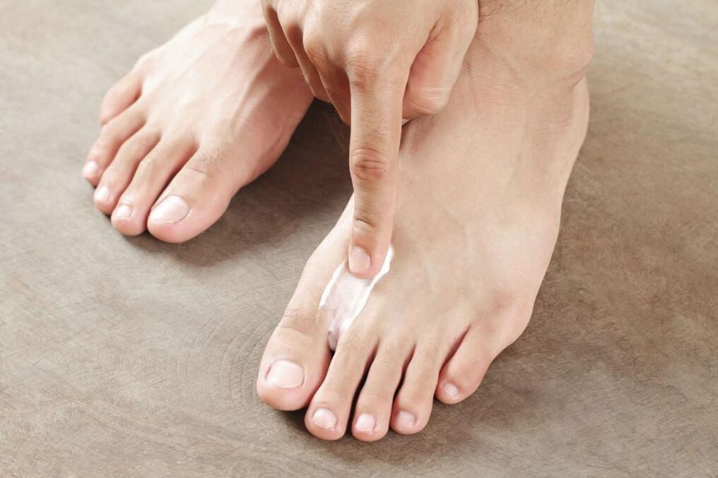 Application of a special ointment to treat the interdigital form of athlete's foot