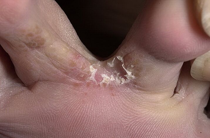 Cracked skin between your toes is a symptom of an intertriginous fungus