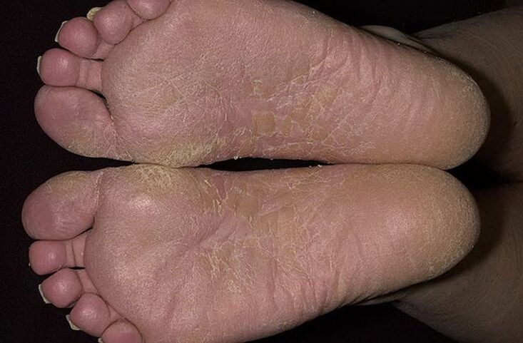 Dry, flaky skin on the feet is a sign of flaky mycoses