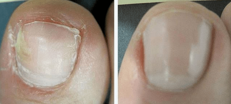 Toenail before and after treating the fungus