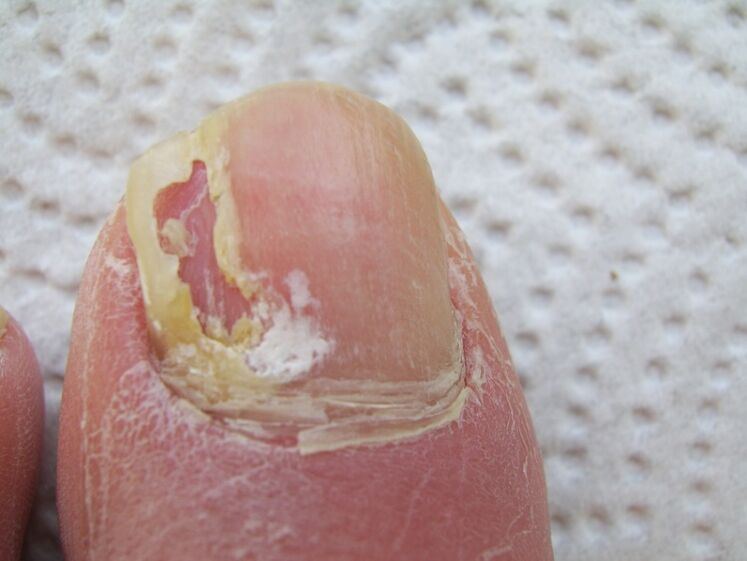 With onychomycosis, deformation of the nail plate occurs