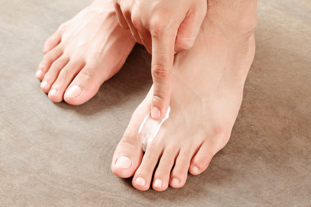 treat the fungus between the toes with ointment