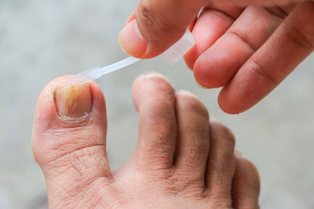 Treatment of athlete's foot