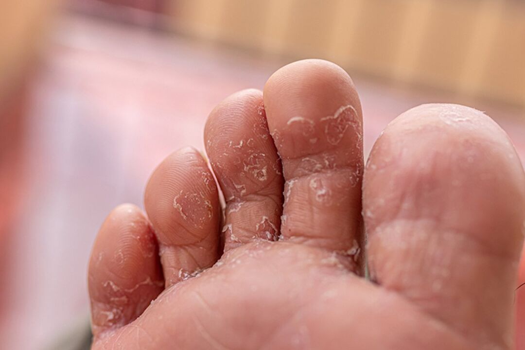 Fungus between the toes