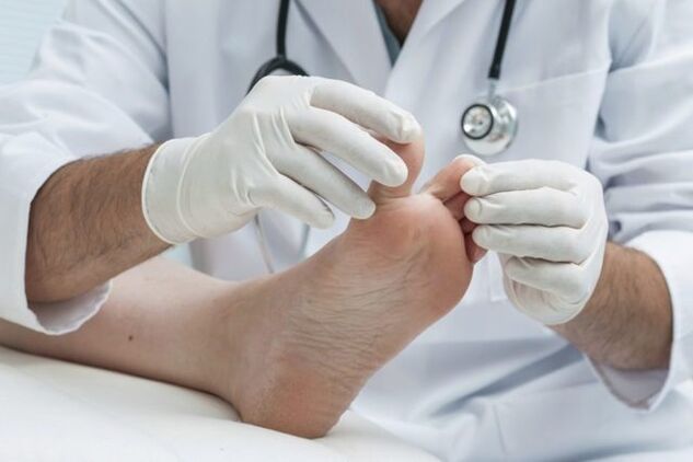 Diagnosis of athlete's foot at the doctor