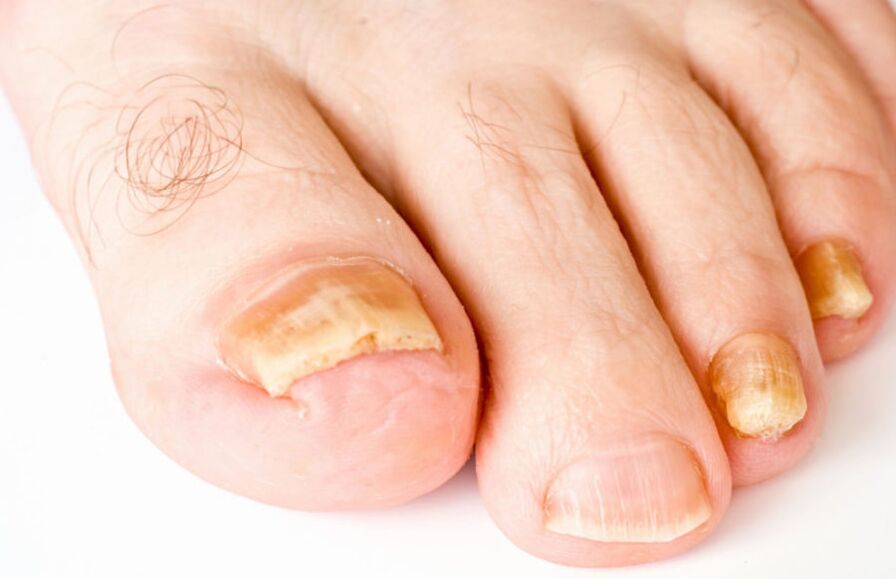 athlete's foot symptoms