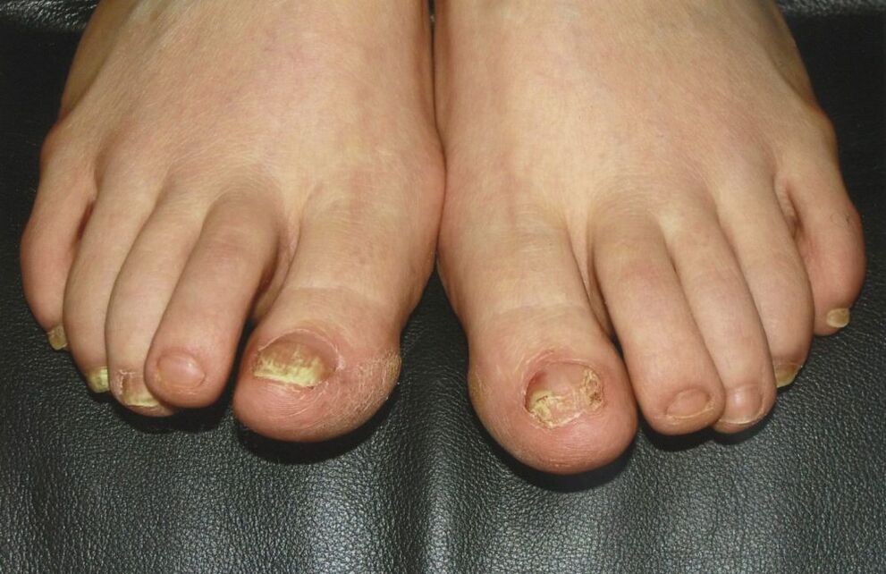 fungus toenails