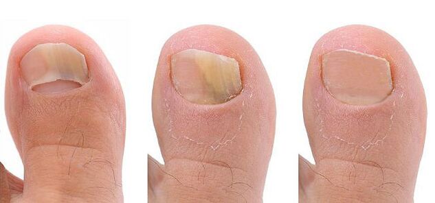 Stages of toenail fungus