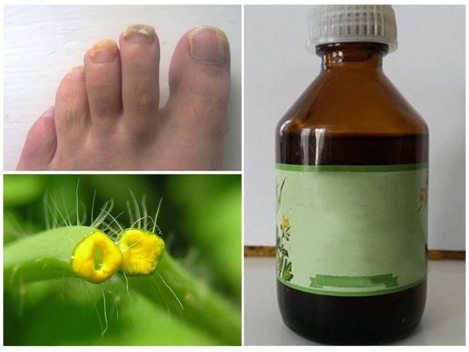 Celandine juice against nail fungus