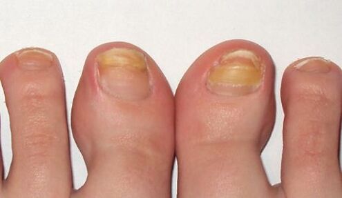 Yellowing of the toenails with fungus