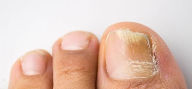 Fungal infection of the nail plate