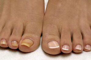 Feet before and after nail fungus treatment