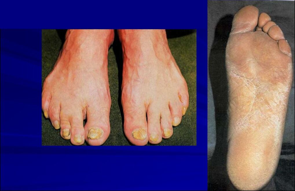 Squamous hyperkeratotic form of the fungus (foot rubromycosis)