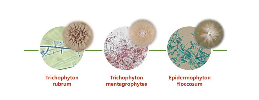 The main causes of skin fungus on the legs