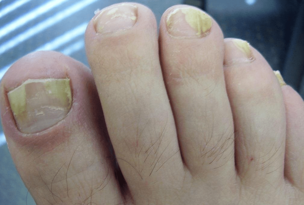 Yellow nails from fungal infection