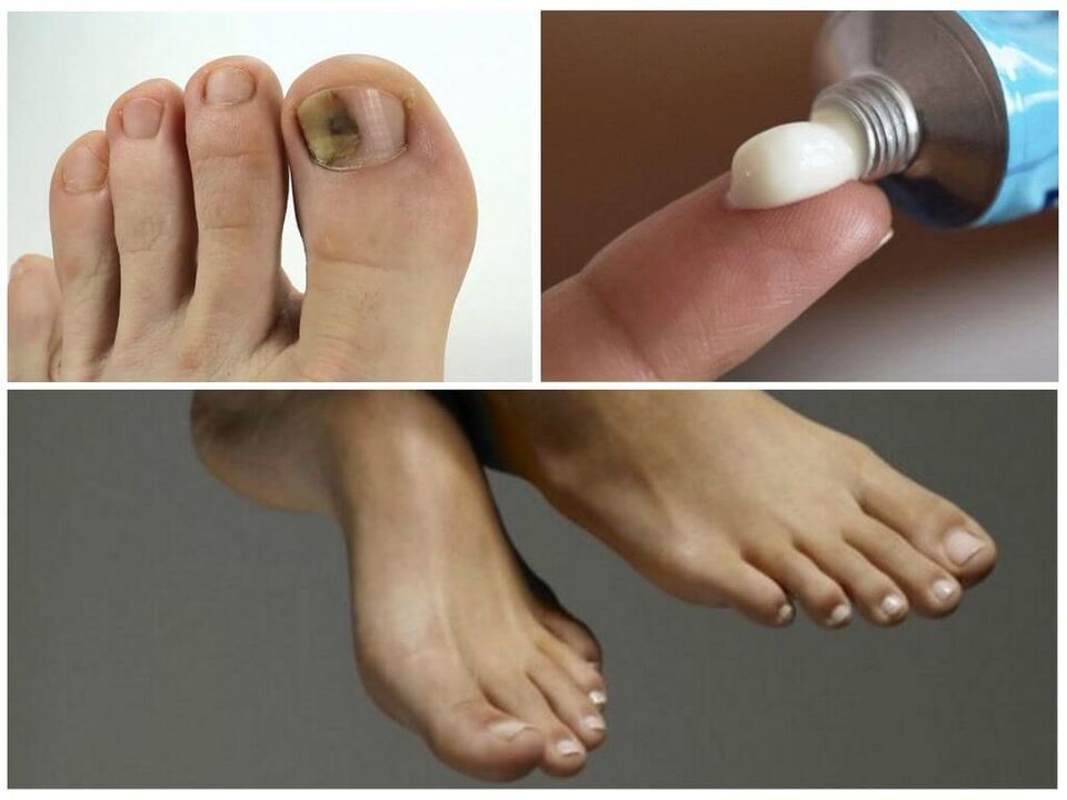 Ointment against nail fungus