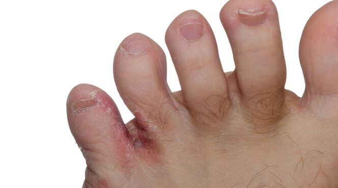 Signs of fungus between toes – cracks and peeling skin