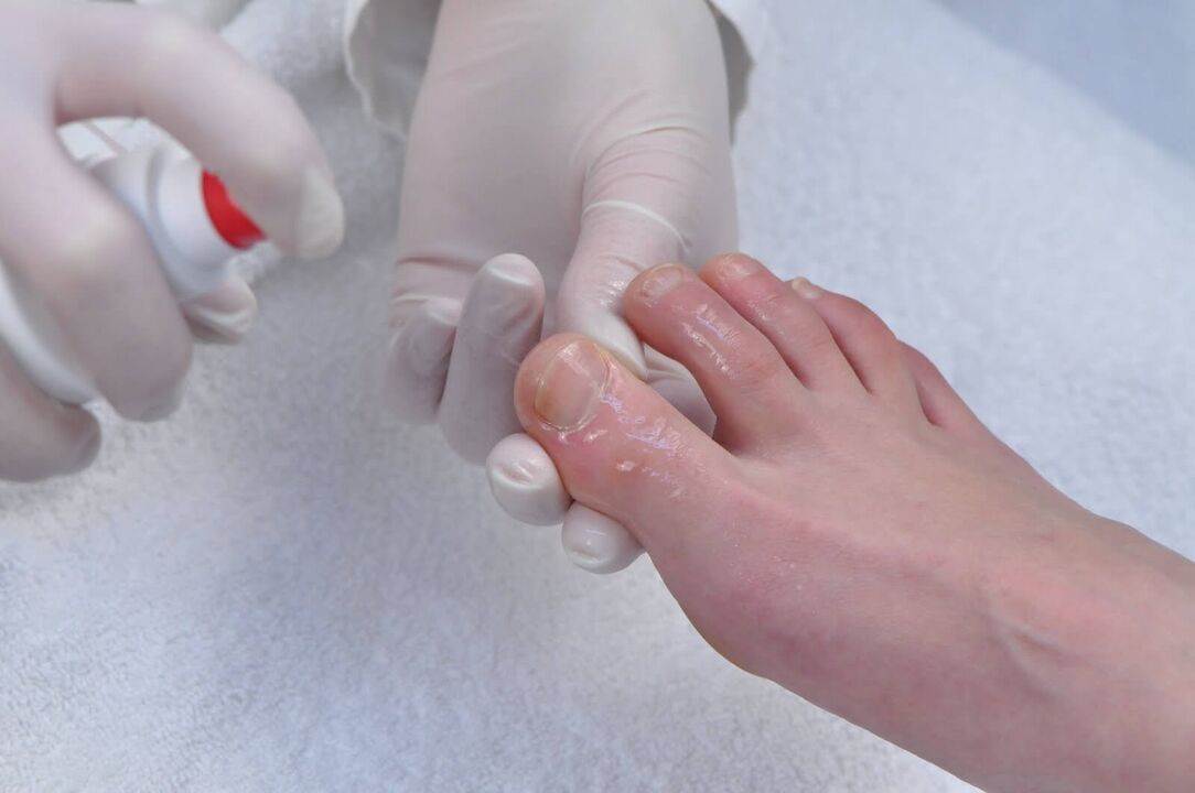 The initial stage of onychomycosis is a reason for diagnostic examination by a dermatologist