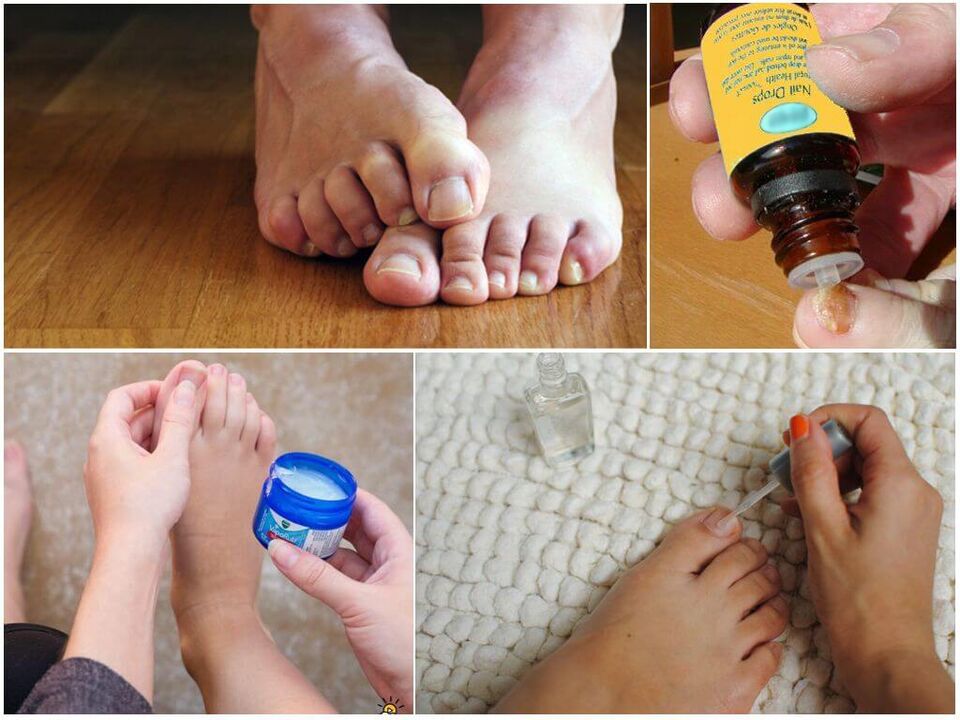 Treating toenail fungus with antifungal solutions, ointments and varnishes