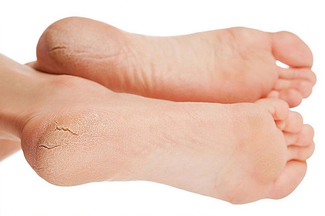 Fungal infection of the feet