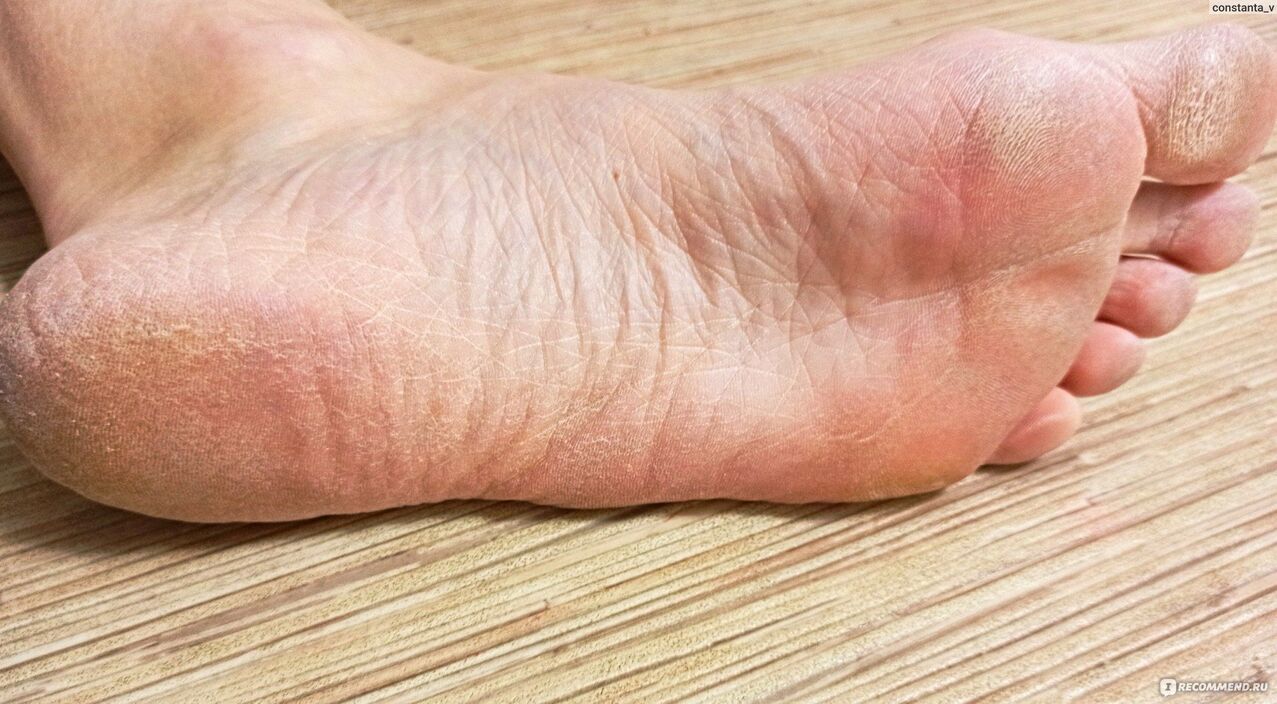 Fungus on human foot